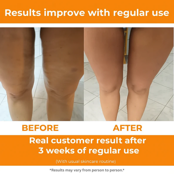 FlexTone™ - Cellulite Massage Roller