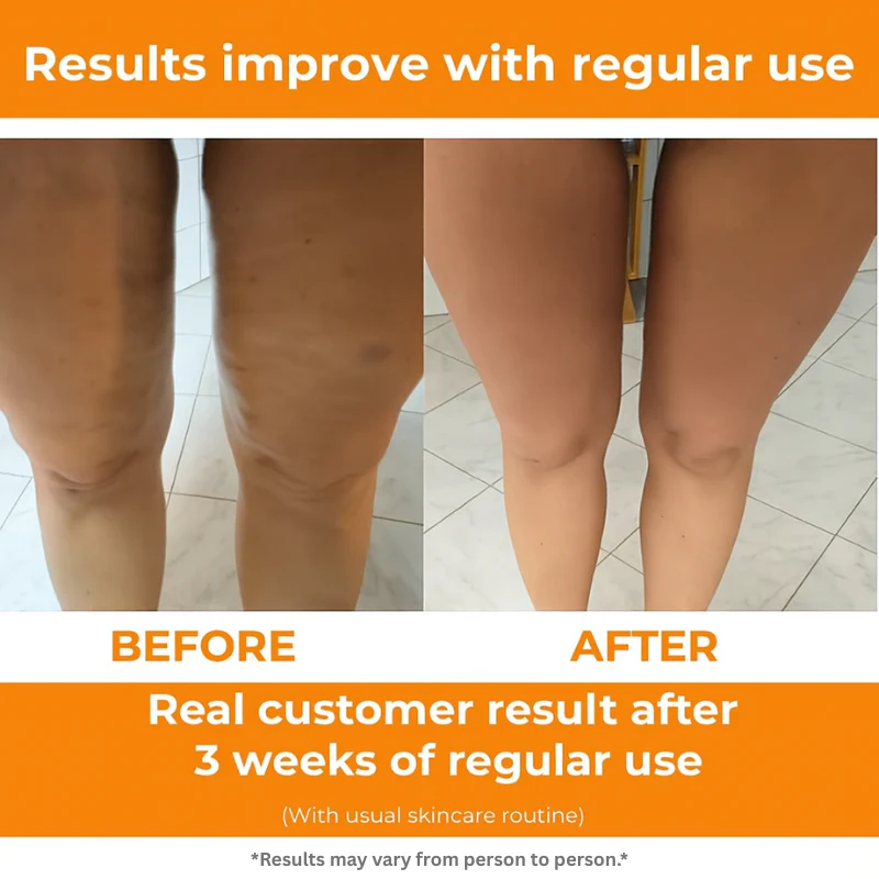 FlexTone™ - Cellulite Massage Roller